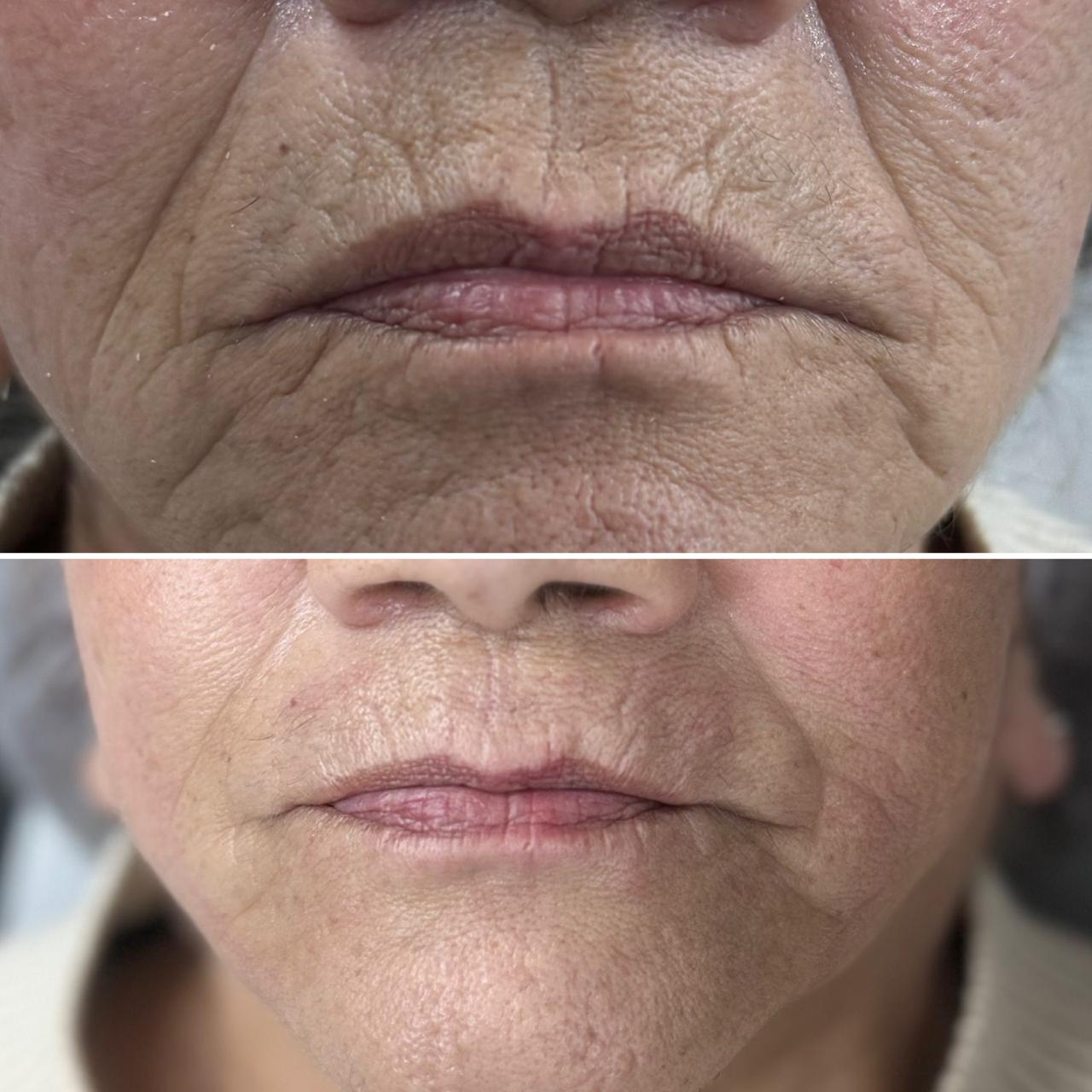 antes y despues CG STYLER SURCO NASOGENIANO 2